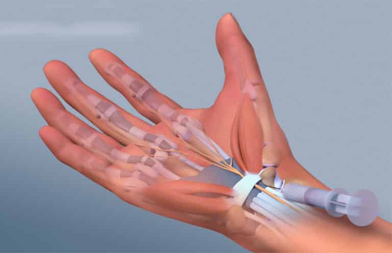 Một số phương pháp chẩn đoán bệnh thoái hóa cổ tay hiện nay