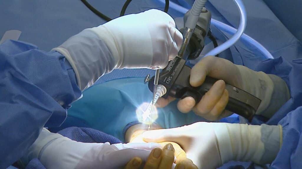 phẫu thuật hội chứng ống cổ tay