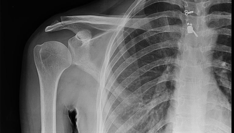 chụp phim X-quang vai giúp chẩn đoán bệnh khớp vai