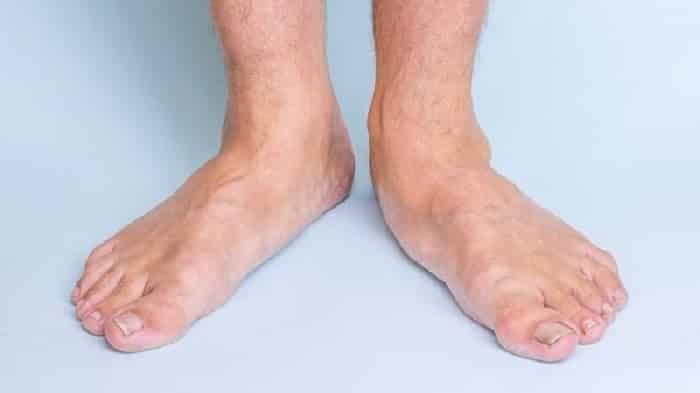 một số dạng bàn chân bẹt
