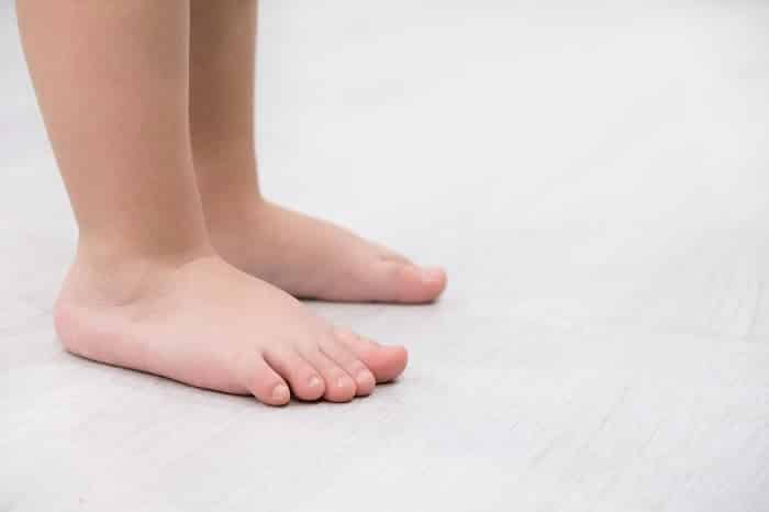 bàn chân bẹt ở trẻ nhỏ