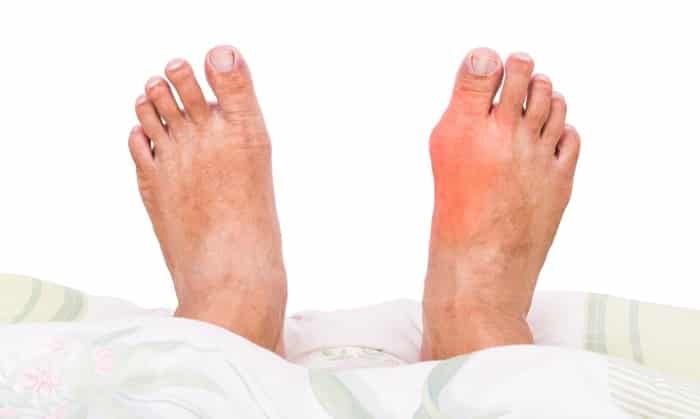 triệu chứng của bệnh gout