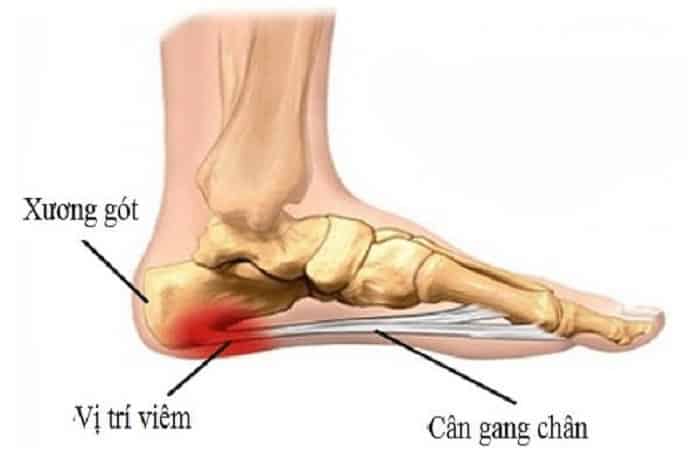 cách chẩn đoán đau gót chân