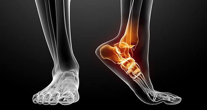 cách chẩn đoán chấn thương lật cổ chân