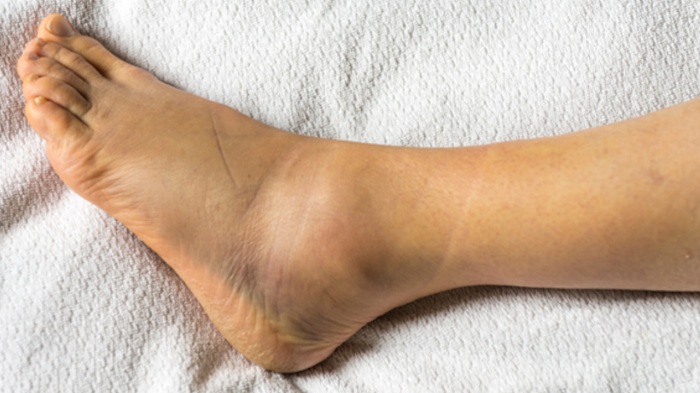 biến chứng nguy hiểm của bệnh viêm khớp cổ chân