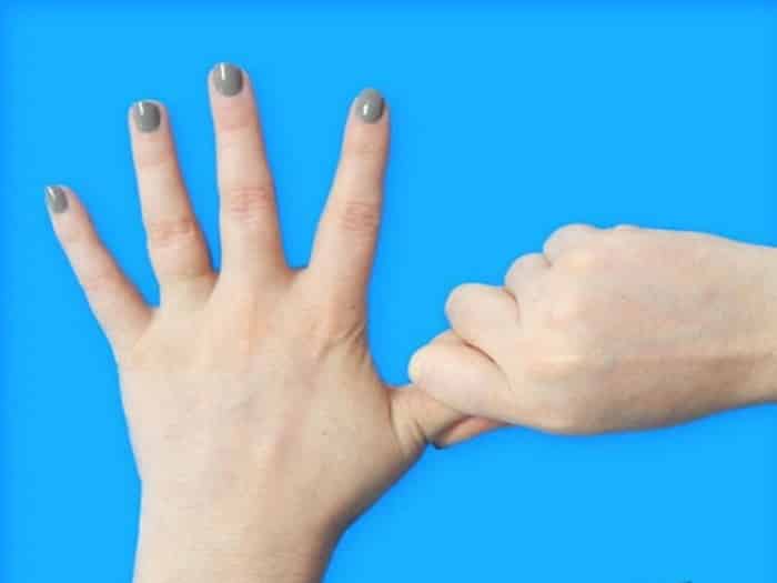 bệnh cứng khớp ngón tay có nguy cơ dẫn đến biến chứng nguy hiểm