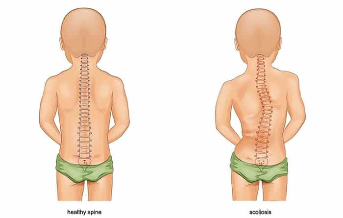 bệnh vẹo cột sống ở trẻ em được phân thành 3 cấp độ
