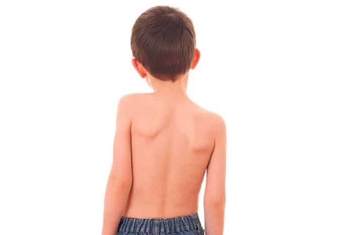dấu hiệu nhận biết bệnh vẹo cột sống ở trẻ em