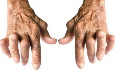 triệu chứng của bệnh viêm khớp dạng thấp