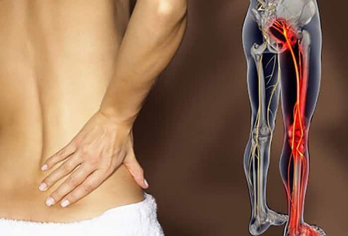 biến chứng của bệnh gai cột sống thắt lưng