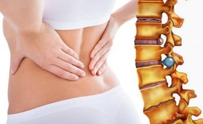 triệu chứng của bệnh phồng đĩa đệm