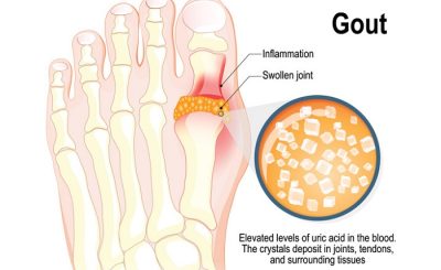 Nồng độ axit uric bất thường cảnh báo về tình trạng sức khỏe