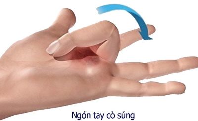 Ngón tay cò súng là gì