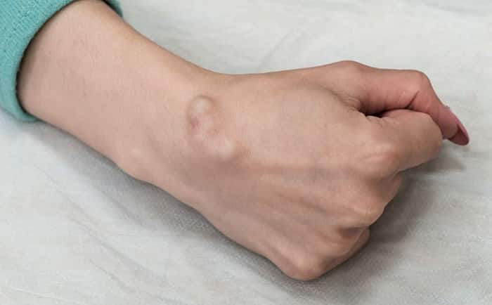 triệu chứng của bệnh u bao hoạt dịch khớp cổ tay