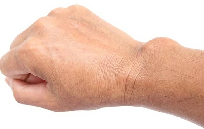 định nghĩa về bệnh u bao hoạt dịch khớp cổ tay