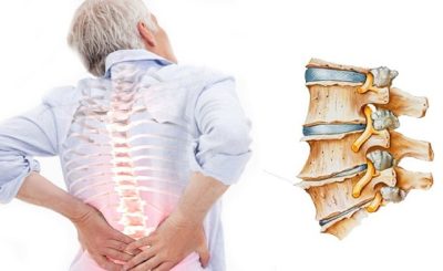 Định nghĩa về bệnh vôi hóa cột sống