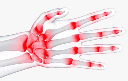 Đau khớp ngón tay là một bệnh lý khá phổ biến hiện nay