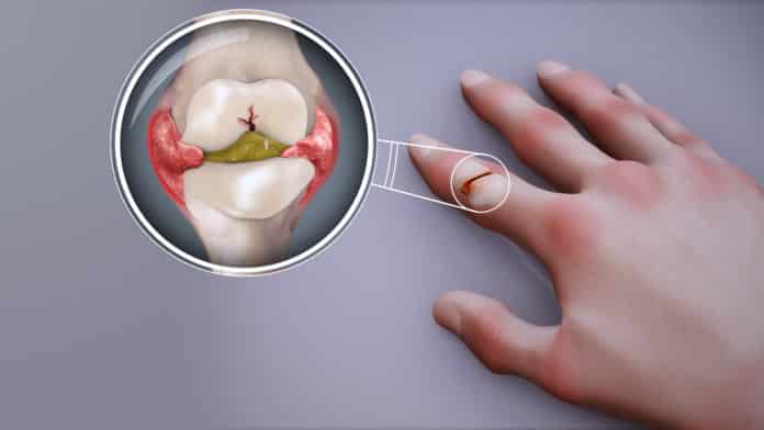 đau khớp ngón tay